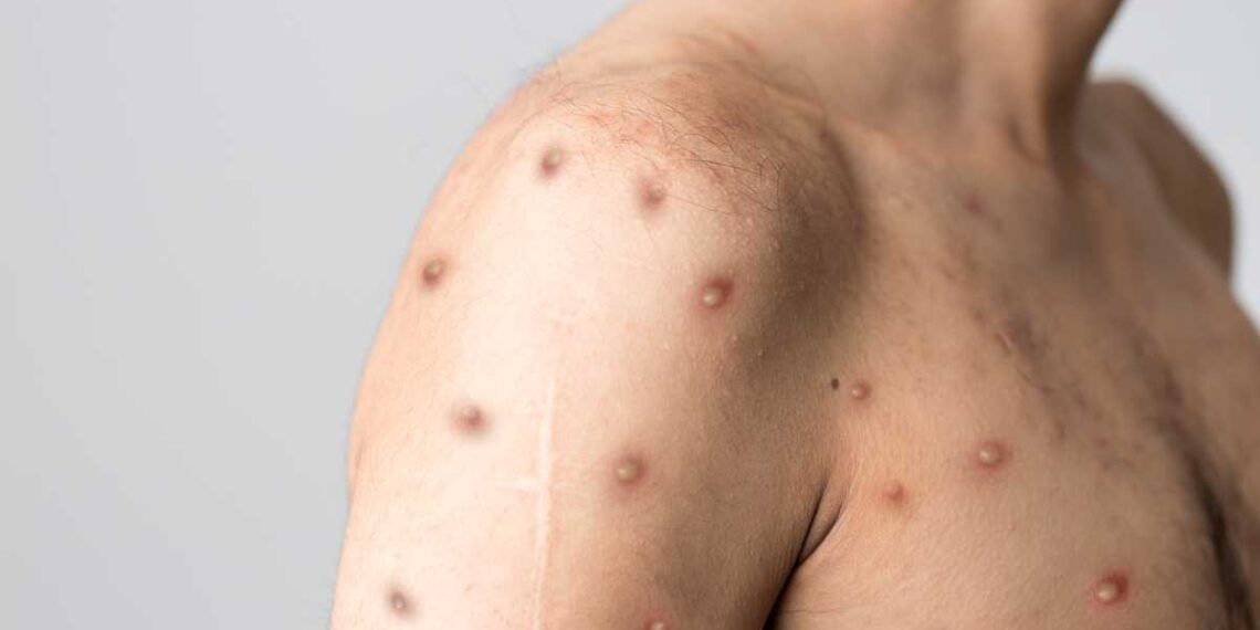 Se registran en México 48 casos de viruela del mono