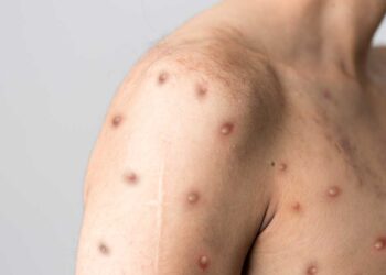 Se registran en México 48 casos de viruela del mono