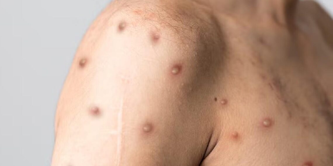 IMSS analiza primer caso sospechoso de viruela del mono en Torreón