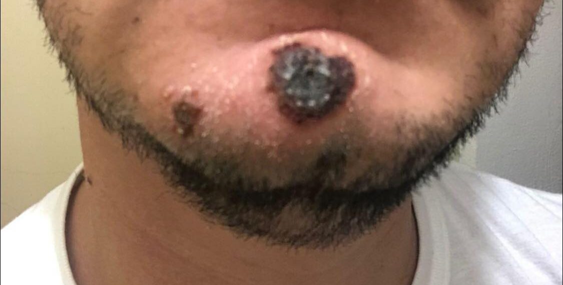 Es de Piedras Negras primer caso confirmado de viruela del mono en el norte de Coahuila; pero radica en Acuña