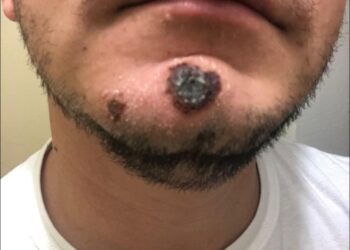 Es de Piedras Negras primer caso confirmado de viruela del mono en el norte de Coahuila; pero radica en Acuña