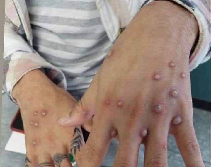 Confirman primer caso de viruela del mono en residente de Piedras Negras