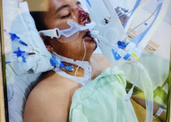 Piden ayuda para joven atropellado por ebrio conductor en PN