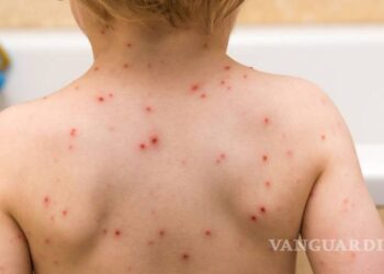 Confirma Jurisdicción Sanitaria de 20 casos de varicela en PN