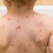 Confirma Jurisdicción Sanitaria de 20 casos de varicela en PN
